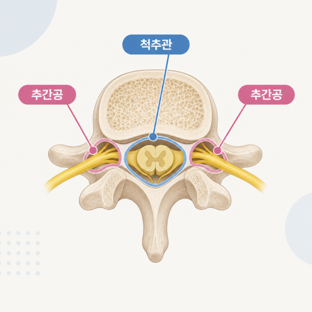 AI 생성 설명 이미지: 서초 한방병원 장덕 한방병원 | 척추관 협착과 추간공 협착, 어느 공간을 말할까요?